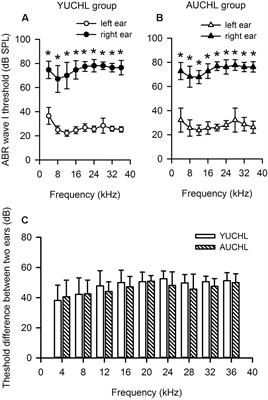 Chronic Unilateral Hearing Loss Disrupts Neural Tuning to Sound-Source Azimuth in the Rat Primary Auditory Cortex